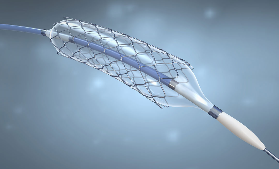 Qualitätsprüfung der Innen- und Außengeometrie von Stents  und Gefäßprothesen